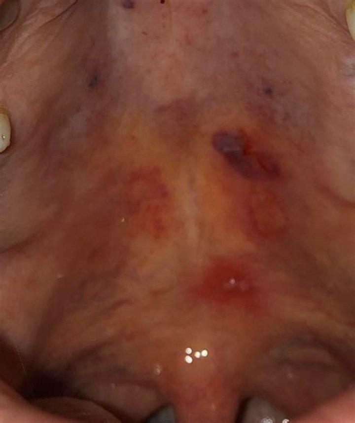 Find Relief: Blood Blister On Roof Of Mouth Causes And Treatment