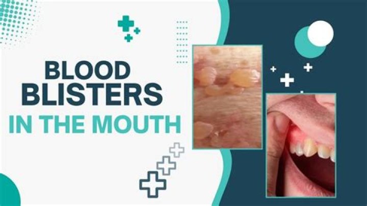 Emergency Relief: Heal Your Painful Blood Blister On The Roof Of Your Mouth
