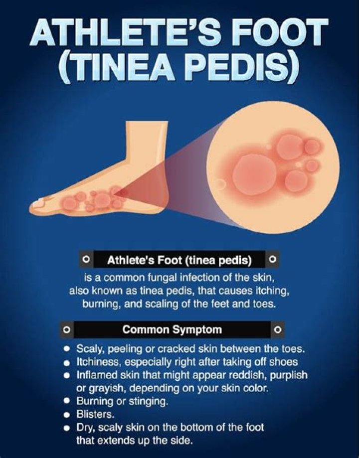 Can You Risk Going In A Hot Tub With Athlete's Foot?