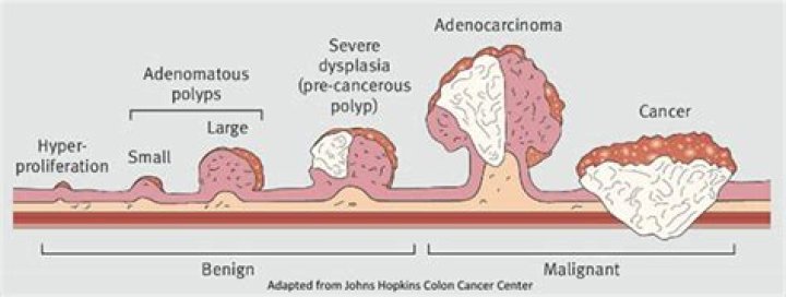 The Ultimate Guide To Colon Nodules Vs Polyps: Everything You Need To Know