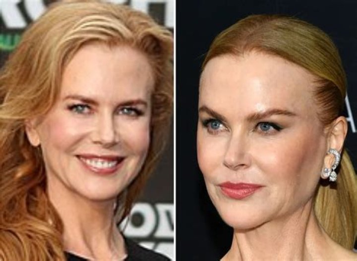 Did Nicole Kidman And Cosmetic Surgery: The Truth Revealed