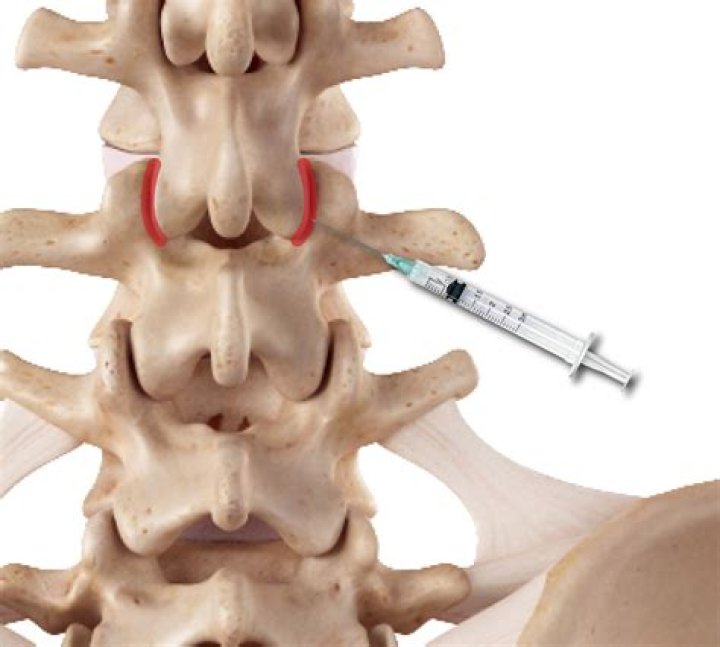 Discover Advanced Facet Arthrosis Treatment Options For Lasting Relief