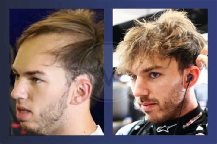 The Ultimate Guide To Gasly Hairlines: Causes, Treatments, And Prevention