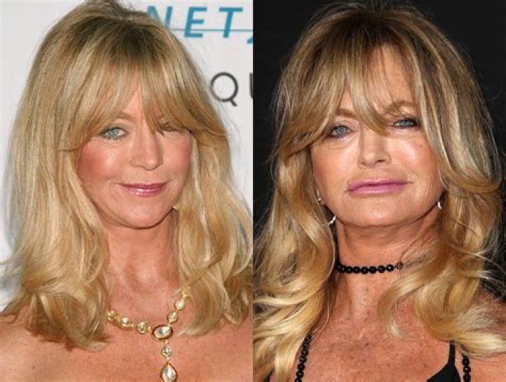 Plastic Surgery Speculations: Examining Goldie Hawn's Transformation