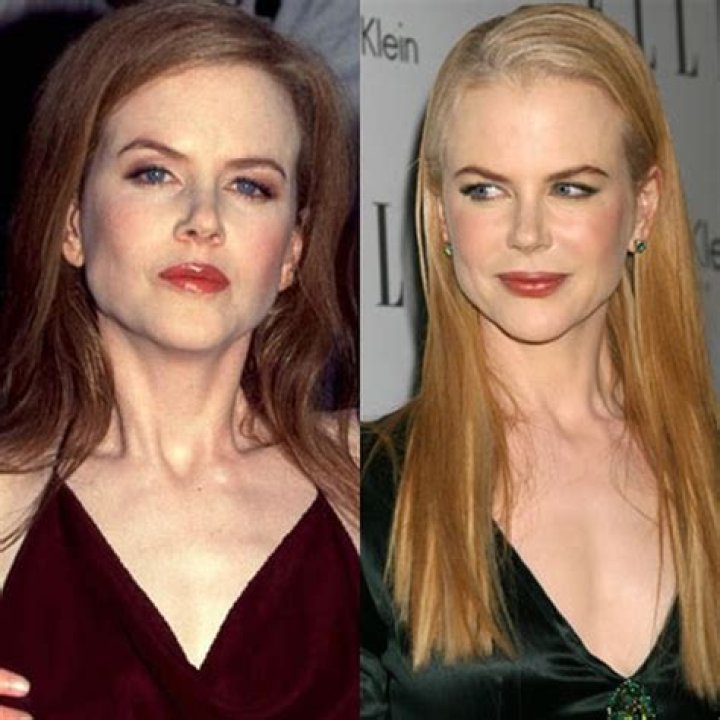 Dr Nicole Kidman's Facelift - Did She Get It?
