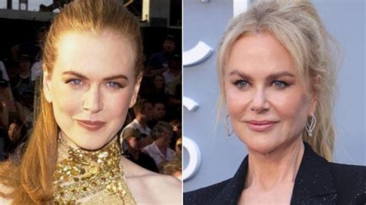 Did Nicole Kidman's Face Get Work Done? The Truth About Plastic Surgery