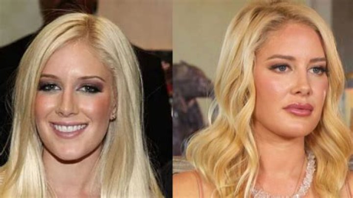 Heidi Montag's Incredible Plastic Surgery Transformation: Before And After