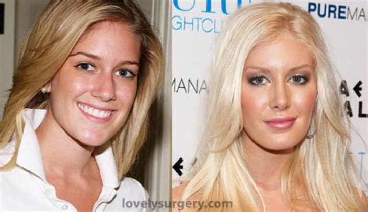 Heidi Montag's Stunning Transformation: Before And After Surgery