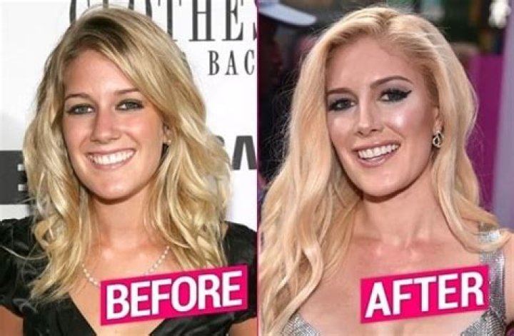 Heidi Montag's Pre-Surgery Transformation: An Unrecognizable Beauty