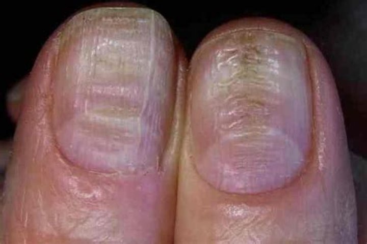 Uncovering The Secrets: Horizontal Ridges In Fingernails Unveiled
