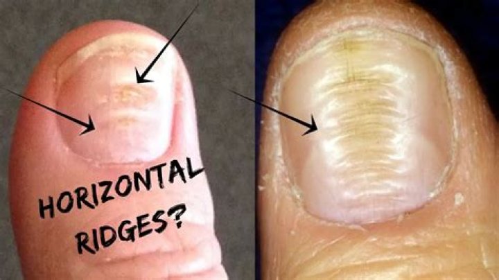 Discover The Meaning Behind Horizontal Nail Ridges: A Guide To Nail Health