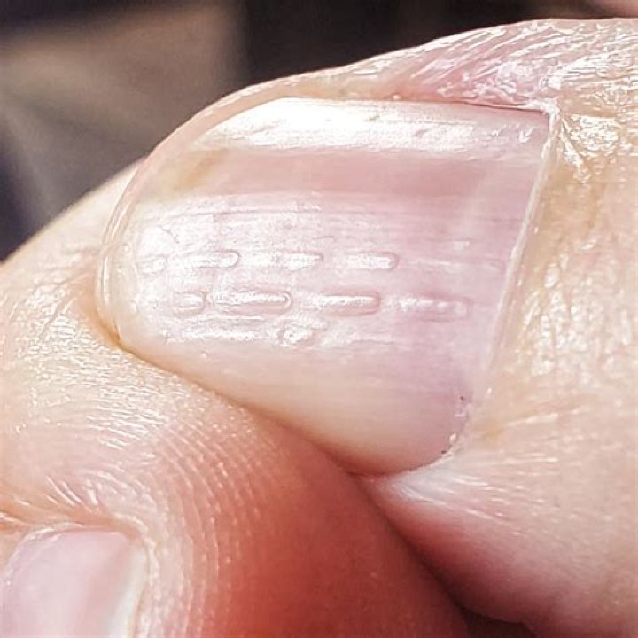 Uncovering The Meaning Of Horizontal Ridges On Finger Nails