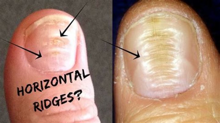Beau's Lines: Uncover The Meaning Of Horizontal Nail Ridges