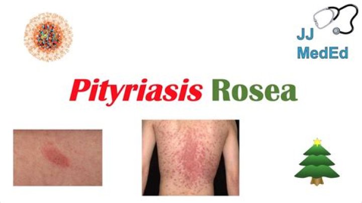 Unveiling The Duration Of Pityriasis Rosea: A Comprehensive Guide