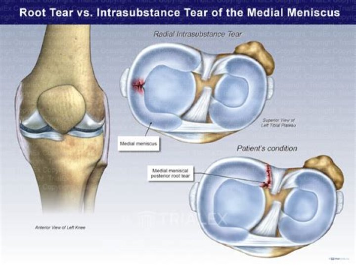 Definitive Guide To Understanding Intrasubstance Tears: Causes, Symptoms, And Treatment