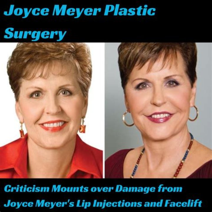 Joyce Meyer's Candid Journey: Uncovering The Truth About Plastic Surgery