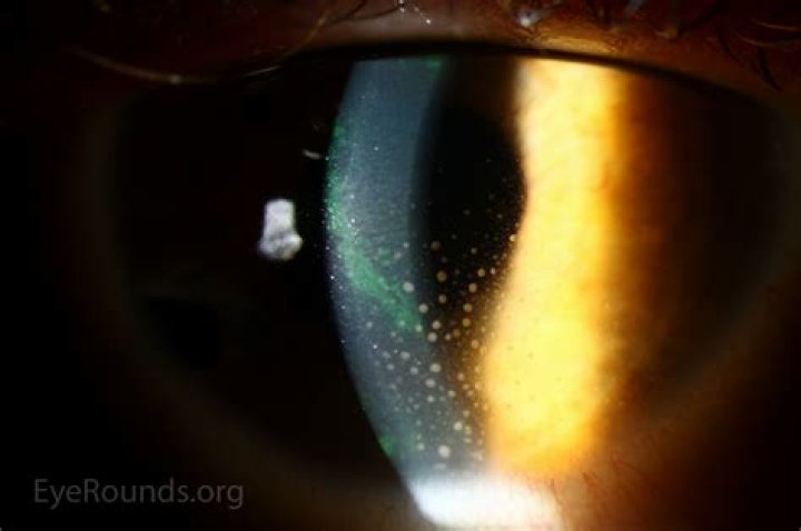 Keratic Precipitates: A Comprehensive Guide To Diagnosis And Management