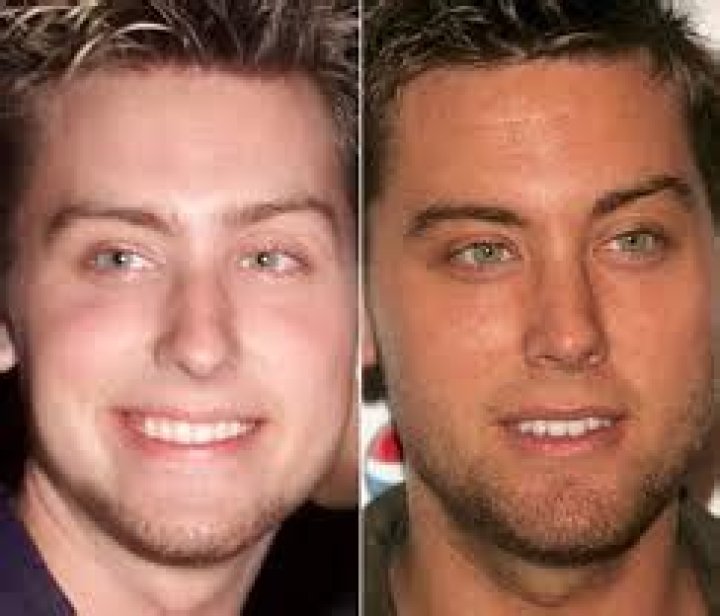 Lance Bass Plastic Surgery: All The Details, Before And After