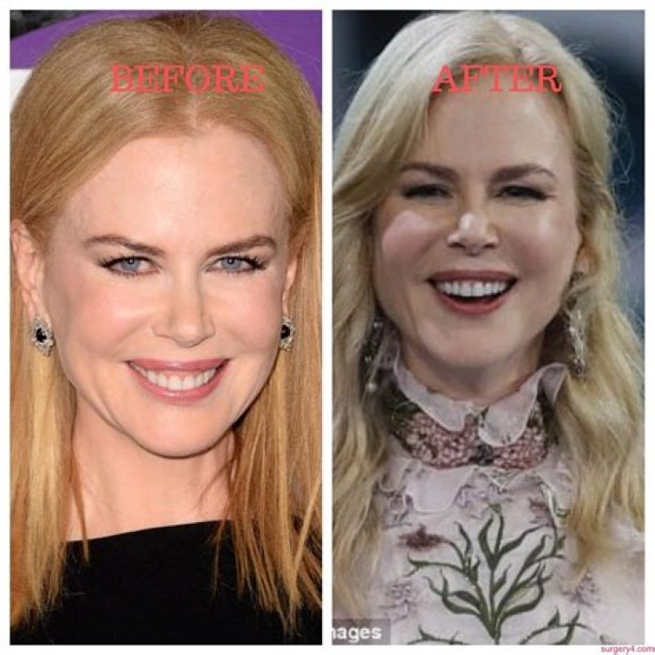 Unveiling Nicole Kidman's Plastic Surgery Transformation: Before And After