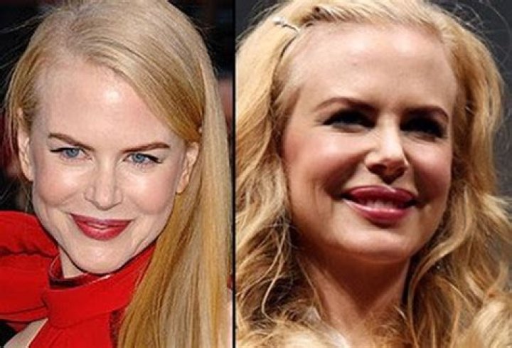 The Complete Guide To Nicole Kidman's Surgery And Recovery