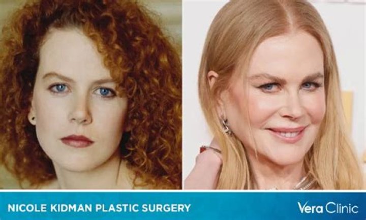 Woman, 54, Looks Like Nicole Kidman After Getting Surgery