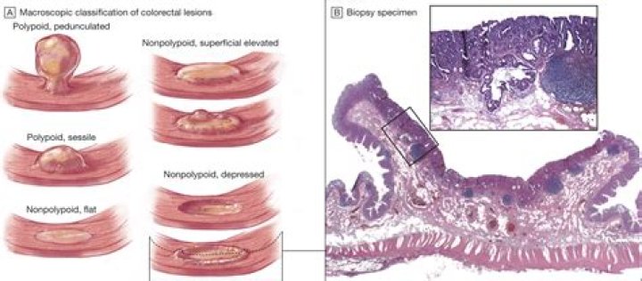 The Key Differences Between Nodules And Polyps