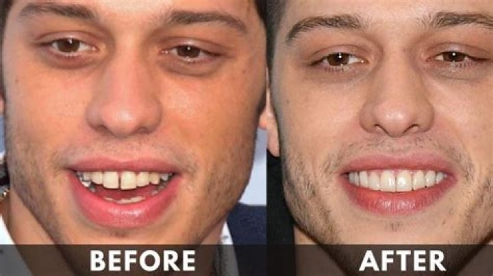 Pete Davidson: Plastic Surgery Unveiled?