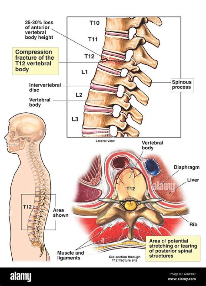 [Location] T12 Vertebra Fracture: Causes, Symptoms, And Treatment Options