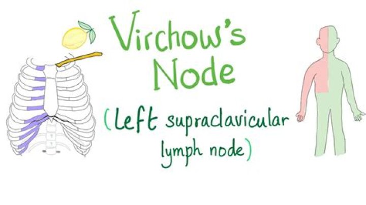 Virchow Node: A Comprehensive Guide To Its Significance In Pathology