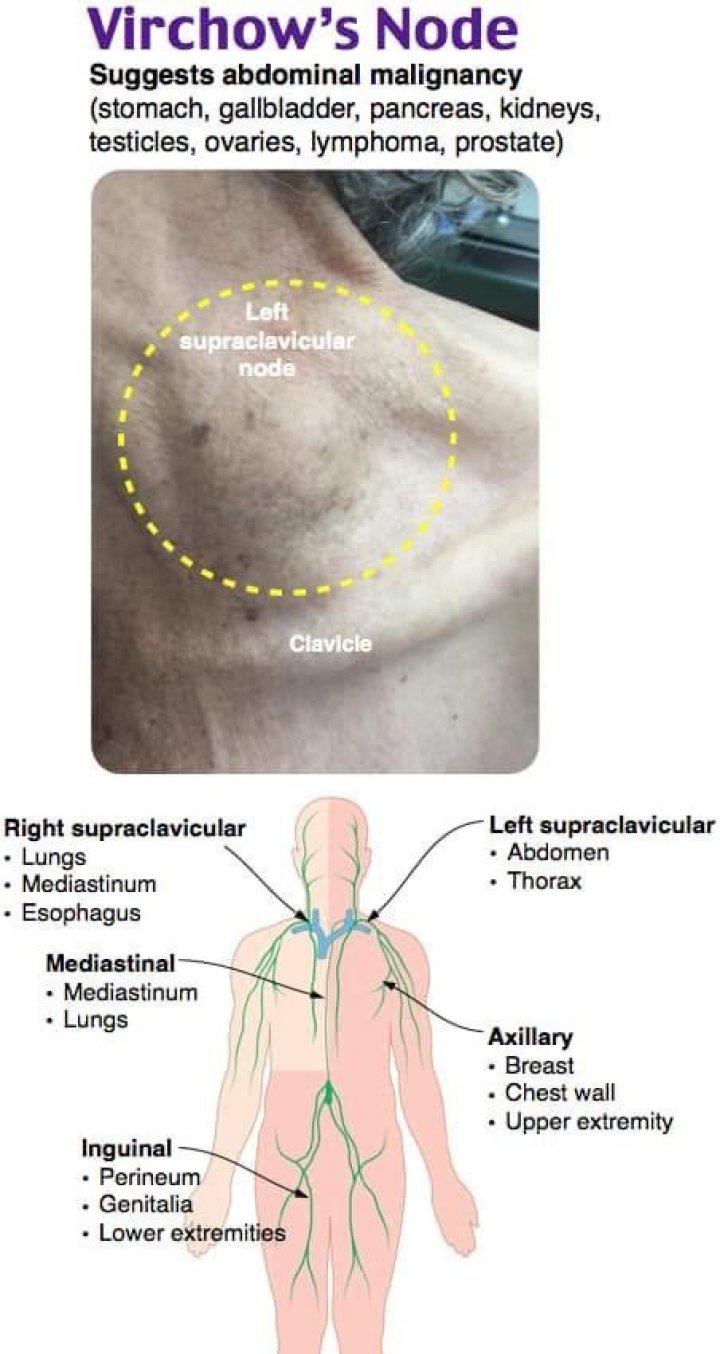 What You Need To Know About Swollen Virchow's Nodes