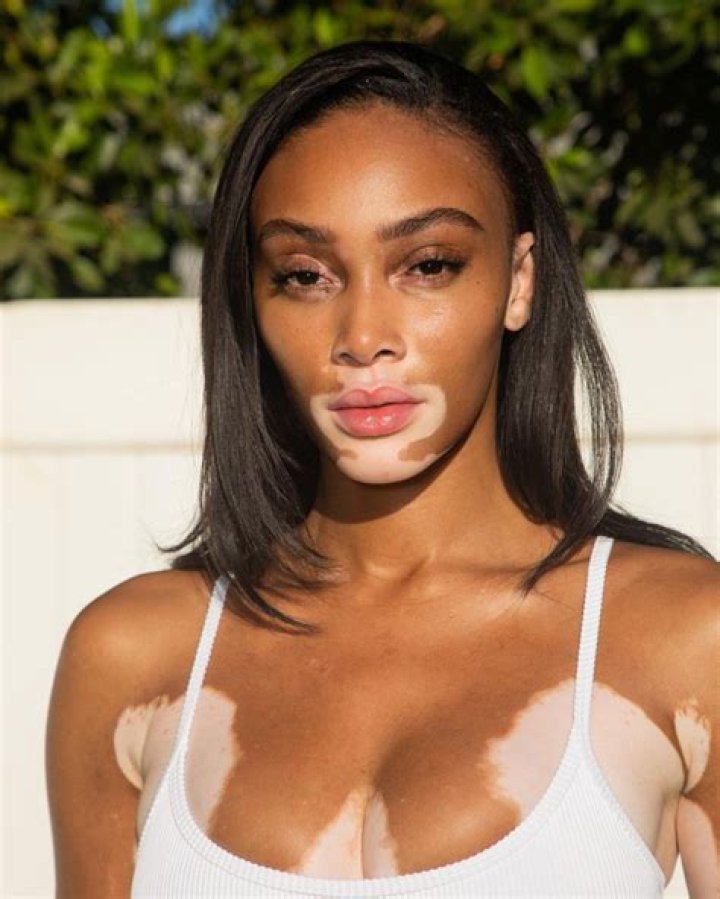 Top Vitiligo Model [vitiligo Model Name] | Inspiring Beauty
