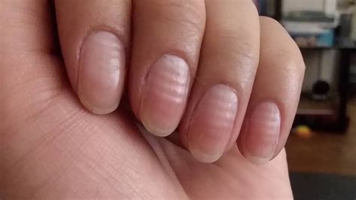 Uncover The Causes Behind Horizontal Nail Ridges: A Comprehensive Guide