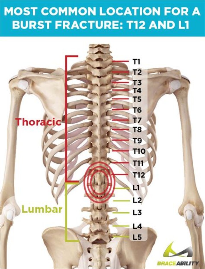 Ultimate Guide To Understanding T12 Fractures