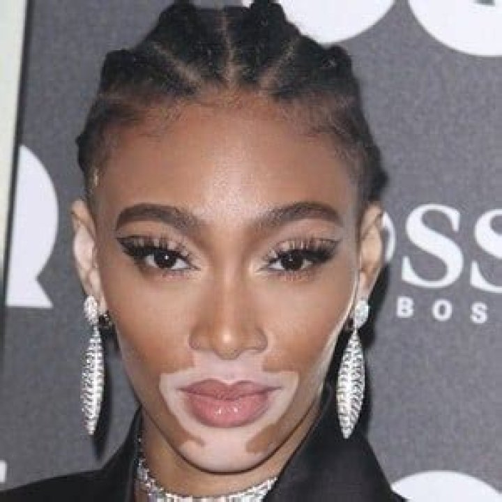 Winnie Harlow's Age: How Old Is The Canadian Model And Activist?
